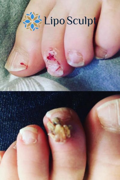 Wart removal customer results from Lipo Sculpt Cherry Hinton